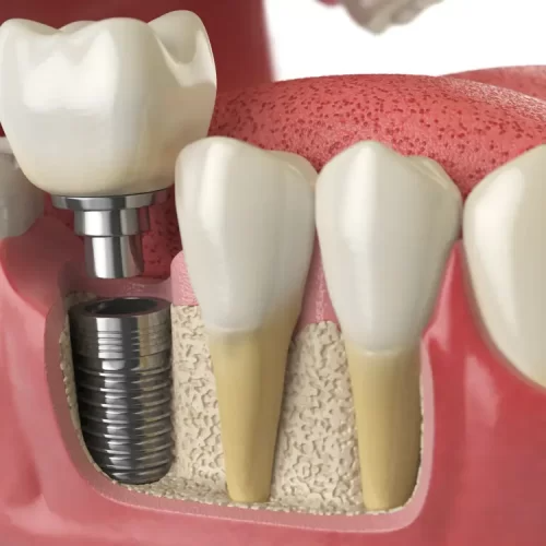 Understanding The Various Types Of Dental Implants